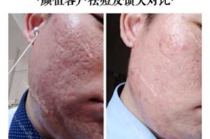 小痘坑怎么修复（小痘坑怎么修复简单方法）
