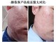 小痘坑怎么修复（小痘坑怎么修复简单方法）