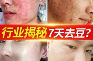 什么去黑头粉刺效果好（什么去黑头粉刺效果好一点）