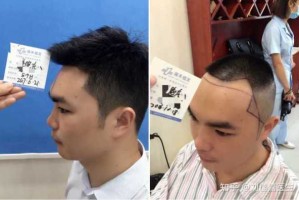 两边发际线太高适合什么发型,发际线两边高怎么办怎么解决