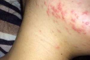 下巴长痘痘怎么治疗,下颚长痘痘怎么治疗最有效