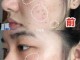 怎么才可以祛痘（怎么才可以祛痘印）