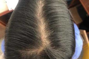 一到秋天头发就掉的厉害，为什么,秋天头发掉的厉害是什么原因引起的