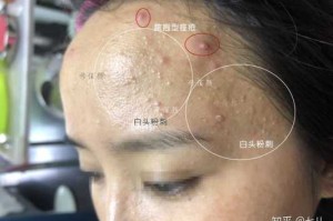 什么是闭口（什么是闭口粉刺）