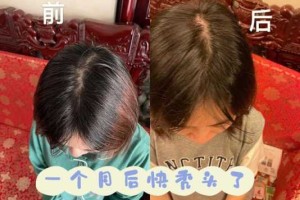 中年人脱发怎么办（55岁以后头发还能生长出来）
