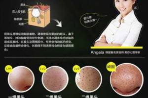 白头粉刺怎么治（怎样去除白头粉刺）