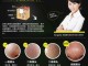 白头粉刺怎么治（怎样去除白头粉刺）