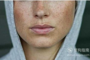 脸上蝇子屎怎么去除,脸上暗疮怎么去除要多长时间