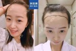 头发怎么3天长5厘米（种植发际线一般多少钱啊）