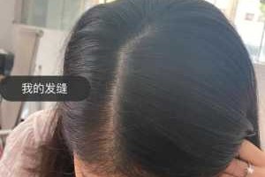头发掉的很多怎么办（掉头发厉害长出来很多短发怎么办）