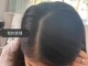 头发掉的很多怎么办（掉头发厉害长出来很多短发怎么办）