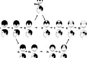 脱发是怎么回事呢（头秃是怎么回事，秃顶的解决办法）