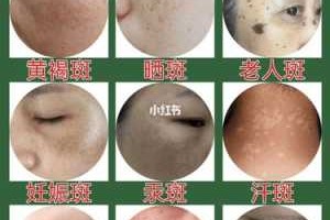 怎么祛斑美容（淡斑消斑的方法有几种）