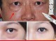 什么去眼袋效果（什么去眼袋效果最好）