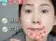 女生下巴长痘怎么调理（下巴长痘痘红肿硬硬的还疼怎么解决）