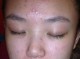 女生长痘痘怎么消除（女生痘痘怎么快速消除）