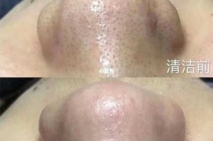 皮肤毛孔堵塞怎么清理（头皮毛囊堵塞怎么清洗）