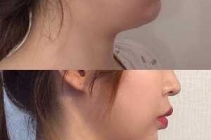 手机下巴宽是指什么,什么是宽下巴和窄下巴