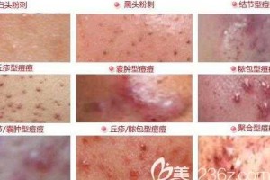 长粉刺怎么调理（长粉刺怎么调理身体）