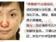 鼻子长痘原因是什么,鼻子上长痘怎么回事?