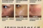 怎样去除雀斑,怎么样去除雀斑黄褐斑