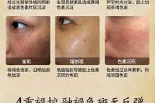 怎样去除雀斑,怎么样去除雀斑黄褐斑