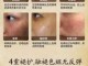 怎样去除雀斑,怎么样去除雀斑黄褐斑