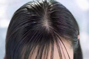 头发容易油是什么原因（为什么前面头发油后面头发不油）
