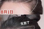 两侧头发开始秃了怎么补救,头发两边秃怎么办女