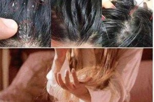 掉头发是什么原因如何防治（头发不油不痒没有头屑，但还是掉发严重）