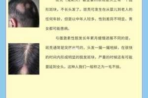 什么是雄性激素脱发（什么是雄性激素脱发）
