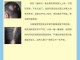 什么是雄性激素脱发（什么是雄性激素脱发）