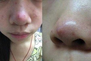 鼻子长痘是怎么回事（鼻子上有痘痘怎么清理）