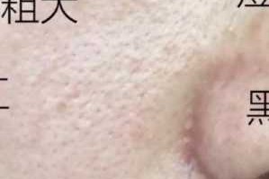 黑头毛孔粗大怎么治（黑头毛孔粗大怎么治）
