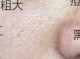 黑头毛孔粗大怎么治（黑头毛孔粗大怎么治）