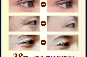眼纹怎么治（眼纹怎么治疗）
