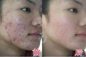 脸上长粉刺怎么去掉（脸上长粉刺怎么去掉?）