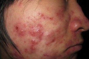 封闭式粉刺如何去除,封闭式痘痘怎么治疗