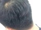 为什么男教师秃头,男的为什么会秃顶的原因