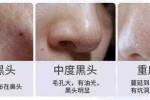 鼻子上好多黑头该怎么去除（鼻子上好多黑头该怎么去除呢）