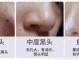 鼻子上好多黑头该怎么去除（鼻子上好多黑头该怎么去除呢）