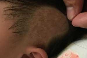 宝贝耳朵两侧不长头发是怎么回事,头顶不长头发怎么办女生