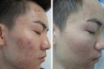 怎么才能去掉青春痘（怎么才能去掉青春痘的方法）
