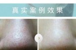 什么去黑头比较好（什么去黑头比较好）