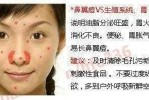 鼻子和嘴巴之间长痘痘是怎么回事,鼻中间长痘痘怎么回事图片