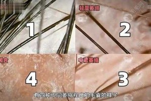 毛囊坏死怎么办（毛囊坏死可以恢复吗）
