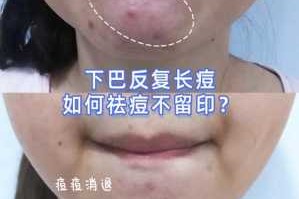 下颚长痘是怎么回事,下巴长痘痘红肿硬硬的还疼怎么解决