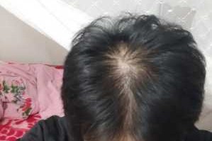 头发少 怎么办（头发少怎么治）