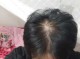 头发少 怎么办（头发少怎么治）