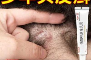 头皮瘙痒怎么治疗（头皮发痒,头上起包是什么病,用什么药好）